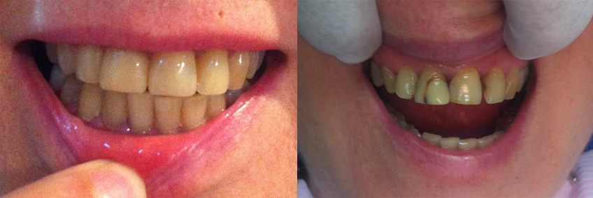 aesthetic-treatments-for-teeth-01-2