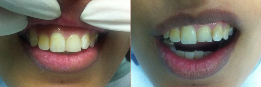 aesthetic-treatments-for-teeth-02-2