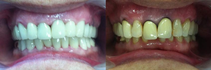 dental-implants-03-1