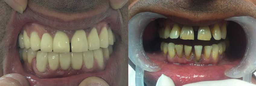 dental-implants-04